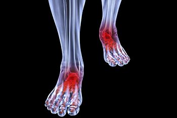 arthritic foot and ankle care treatment in the Vancouver (Kitsilano, Kerrisdale, West Point Grey), Burnaby, Richmond, New Westminster, Surrey, Coquitlam, Port Moody, West Vancouver, North Vancouver areas