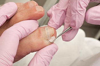 Ingrown toenails treatment in Vancouver (Kitsilano, Kerrisdale, West Point Grey), Burnaby, Richmond, New Westminster, Surrey, Coquitlam, Port Moody, West Vancouver, North Vancouver areas
