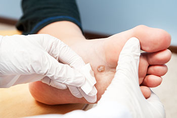 Plantar warts treatment in the Vancouver (Kitsilano, Kerrisdale, West Point Grey), Burnaby, Richmond, New Westminster, Surrey, Coquitlam, Port Moody, West Vancouver, North Vancouver areas